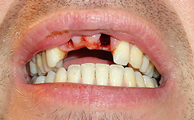 teeth injuries7
