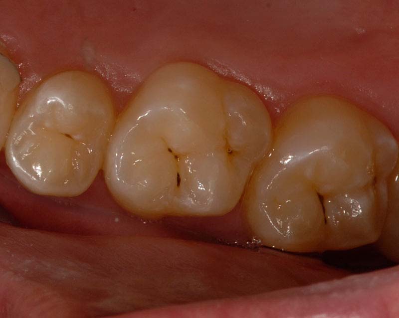 izgled zuba sa prebojenostima u fisurama large