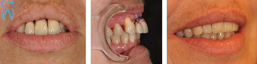 Διόρθωση άνω χείλους μέσω της διόρθωσης των δοντιών